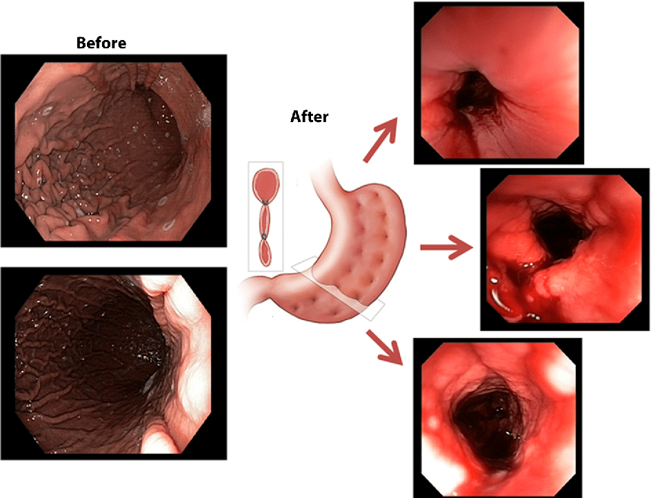 Endoscopic gastroplasty